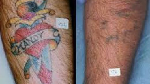 Tattoo Removal – What You Should Expect After A Tattoo Removal Procedure