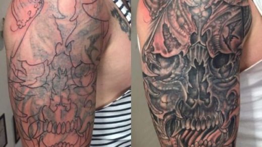 An An Overview Of Tattoo Removal Techniques