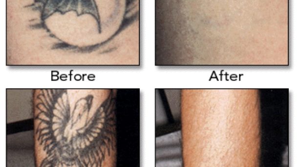 How Much Does Tattoo Removal Cost? Close Your Wallet And Find Out