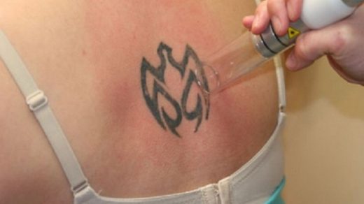 Tattoo Removal Methods And Considerations