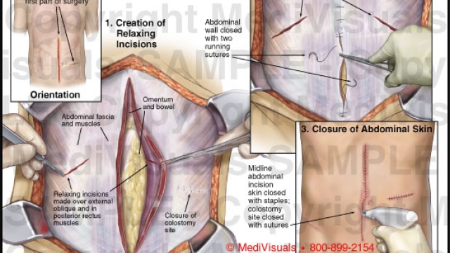 Tummy Tucks: Transforming Your Abdominal Aesthetics