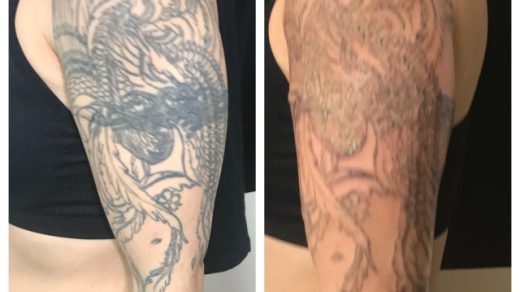 Tattoo Removal – Liberate Yourself From That Tat