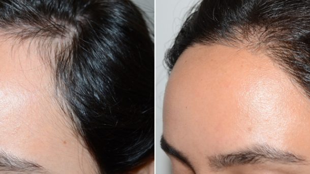 Unlocking the Confidence Boost: Everything You Need to Know About Hair Implants