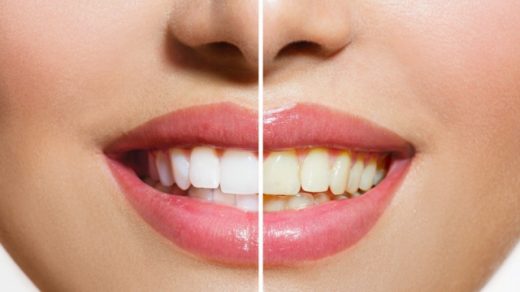 Flashing Pearly Whites: Unveiling the Secrets of Teeth Whitening