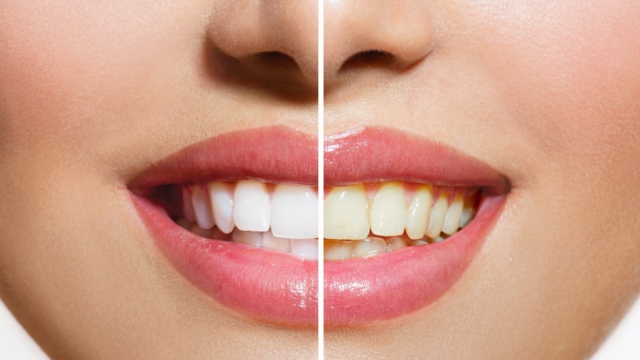 Flashing Pearly Whites: Unveiling the Secrets of Teeth Whitening