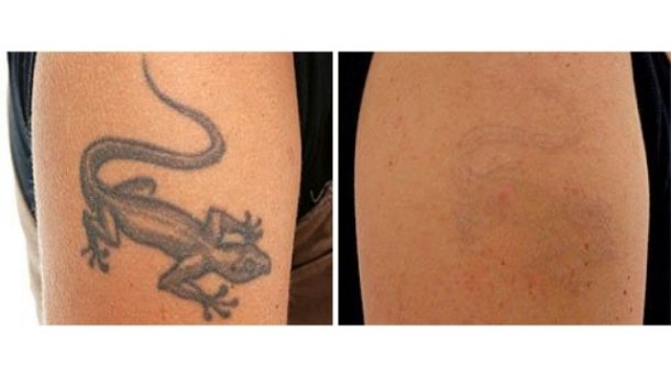How To Advance A Laser Tattoo Removal Cost