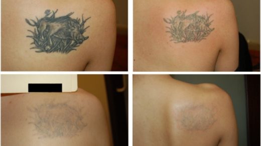 Laser Tattoo Removal – How Long Does It Take?