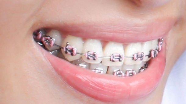 A Smile Transformation: Exploring the Benefits of Orthodontists and Private Dentists