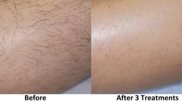 Smooth and Silky: Unleashing the Magic of Laser Hair Removal