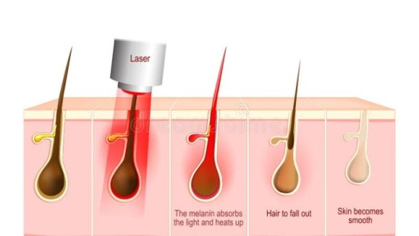Smooth Skin Solutions: Exploring the World of Laser Hair Removal