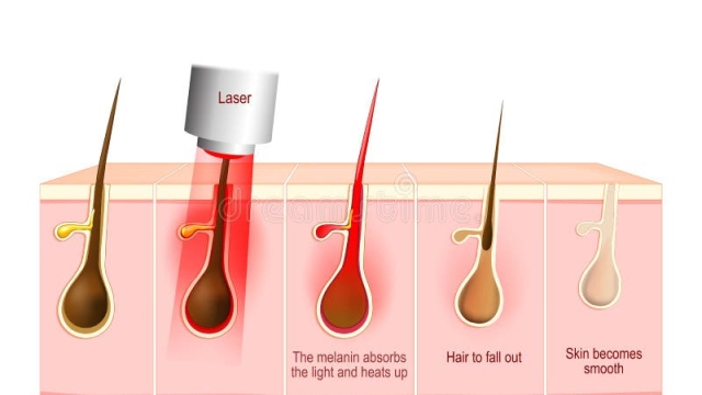 Smooth Skin Solutions: Exploring the World of Laser Hair Removal